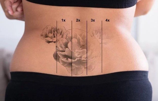 How Many Sessions Does It Take to Completely Remove a Tattoo?