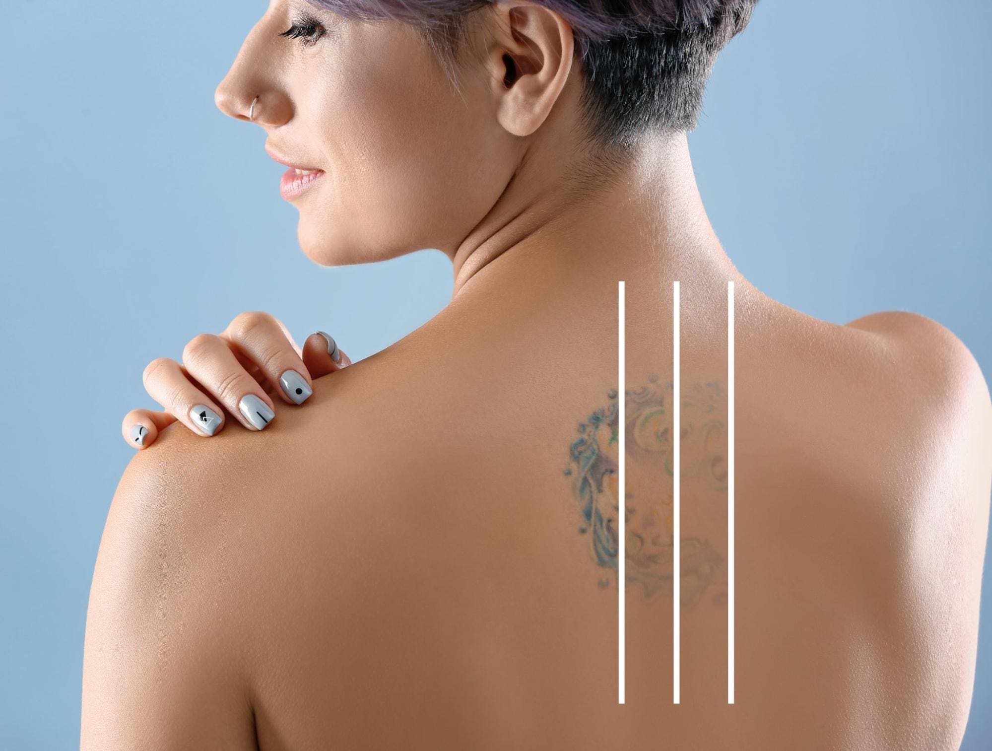 Facts About Laser Tattoo Removal